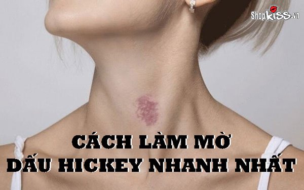 Cách làm mờ dấu hickey nhanh nhất hãy áp dụng ngay!