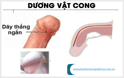 Dương vật bị cong xuống có ảnh hưởng gì không?