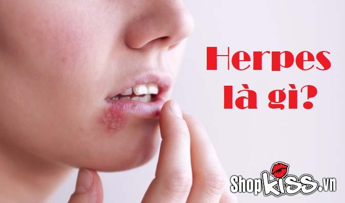 Herpes là gì? Những điều bạn cần biết về bệnh Herpes và cách điều trị