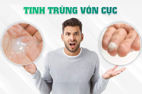 Bật mí 8 nguyên nhân khiến tinh trùng vón cục nam giới