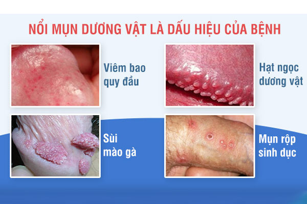 Dương vật nổi mụn là bệnh gì và phương pháp điều trị